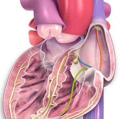 heart diagram showing leads for EP study